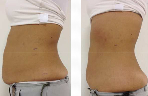 Io S21 Before & After Tummy
